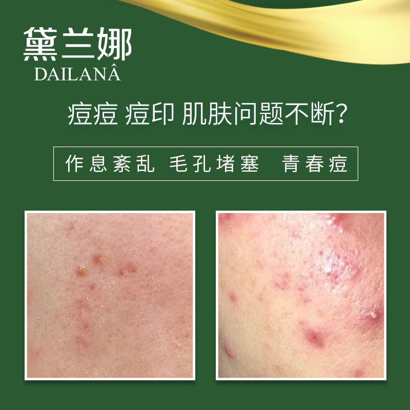 黛兰娜清痘修护精油
