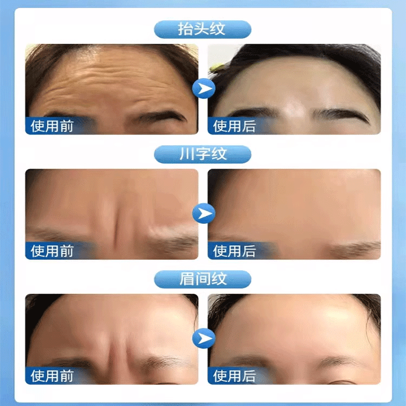 凝水微晶贴神器4d淡化法令纹嘴角纹额头贴抗初老去皱提拉紧致正品