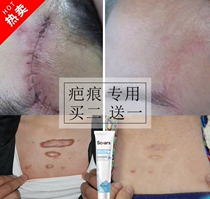 Removal of Hyperplasia Hard Knots Chest Front Raised Repair Paste Stitch Needle Surgery Recessed Scar Old Scar Scar Removal And Rugged Scar