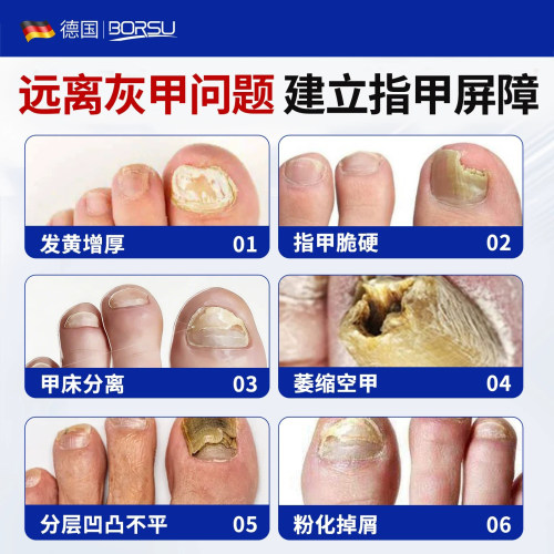 德国BORSU灰指甲专用甲沟正品旗舰店趾指甲膏冰醋酸涂剂剪指刀炎 - 图2