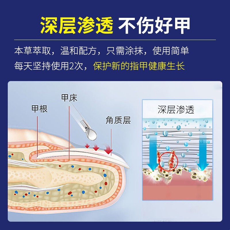 修正脱甲膏去旗舰店灰指甲专用液 卡提鸟保健用品保健理疗