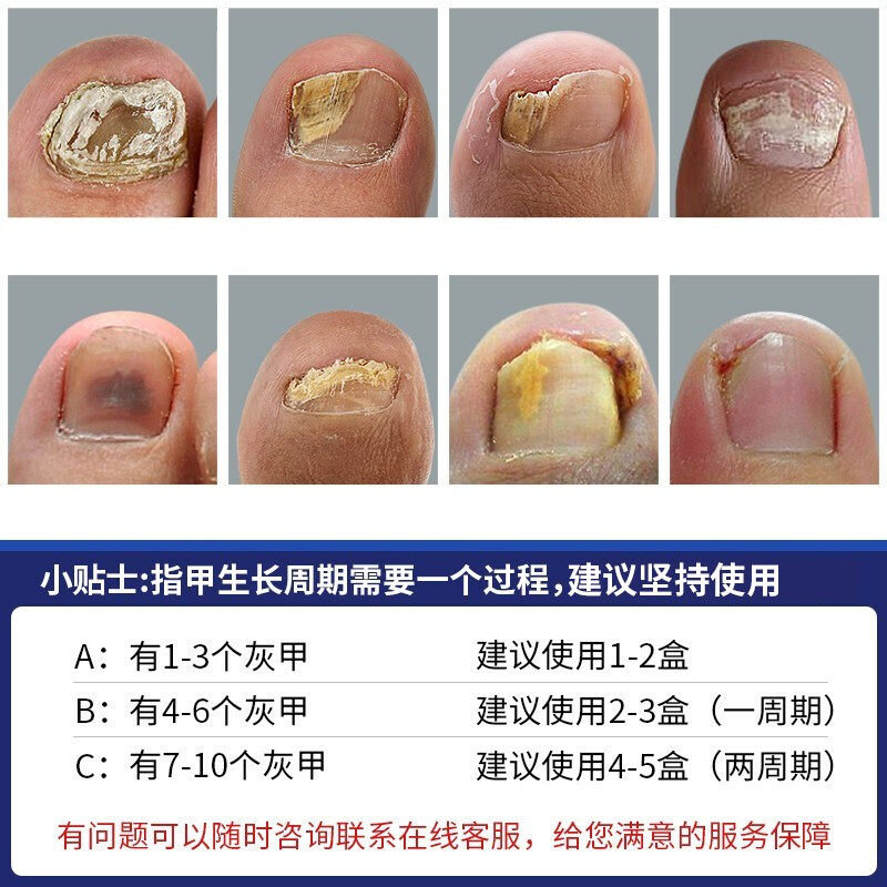 修正脱甲膏去旗舰店灰指甲专用液 卡提鸟保健用品保健理疗