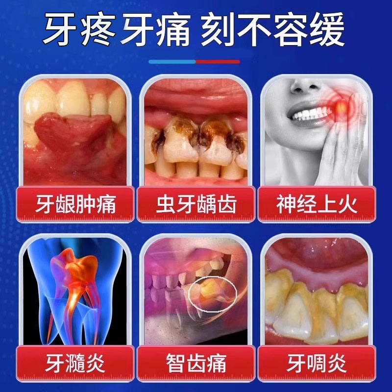 牙髓炎特牙痛智齿消炎牙疼专用牙龈肿痛效非牙膏药房同售牙周炎RO-图0