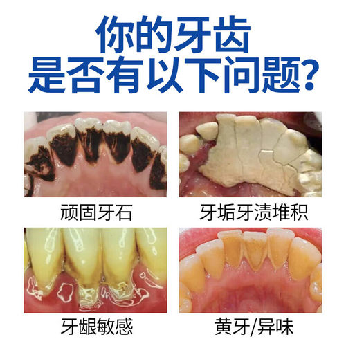 牙结石溶解医用漱口水杀菌牙周炎除口臭去牙石速效清理消炎簌祛RO-图0