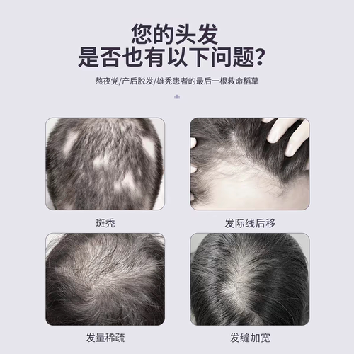 西德瑞电动头皮纳米微晶男女生用头发微针中胚层导入家用促吸收仪 - 图1