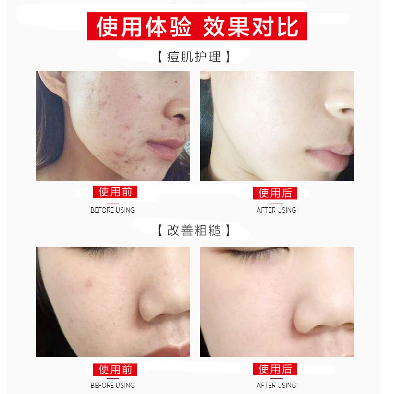 里海传说多肽精华去淡化痘印冻干粉 里海传说液态精华