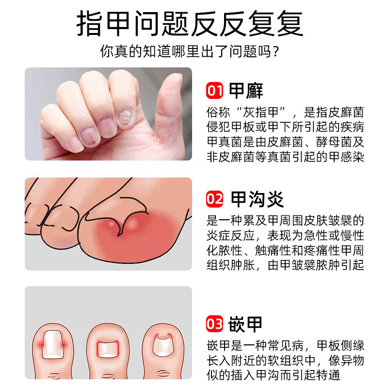 冰醋酸30灰指甲抗菌抑菌甲沟炎药 小禾诗蔓医疗器械保健理疗