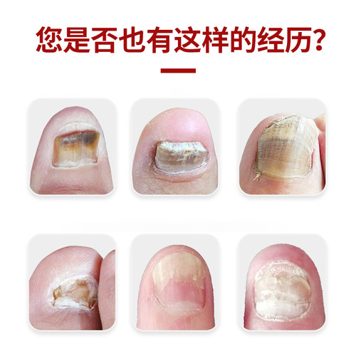 王泰林正品灰甲康护理液软甲脱甲沟脚气护理液 - 图0