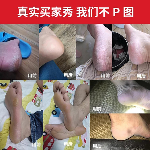 日本搓脚板去死皮老茧家用磨脚器石脚后跟锉脚皮刮脚底修脚神器刀 - 图2