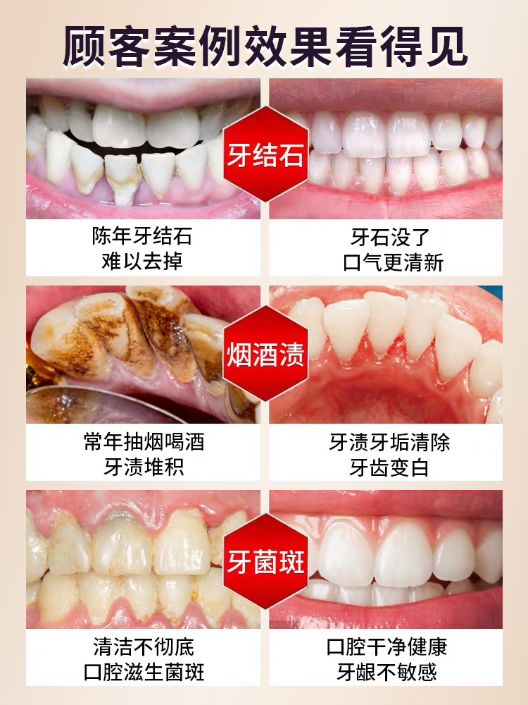 声波冲洗牙结石超去除器洁牙仪牙石牙垢污渍家用矫正牙齿清洁神器-图2