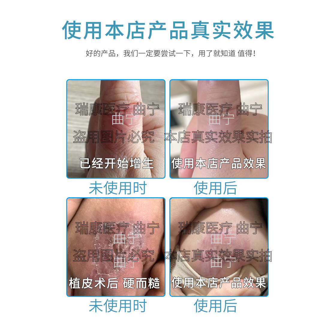 曲宁医用弹力手套胳膊臂套疤痕增生加压烧烫伤压力套防增生,淘宝优惠券,粉丝福利购,淘宝优惠卷