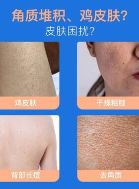 尿素维E软膏改善鸡皮软膏