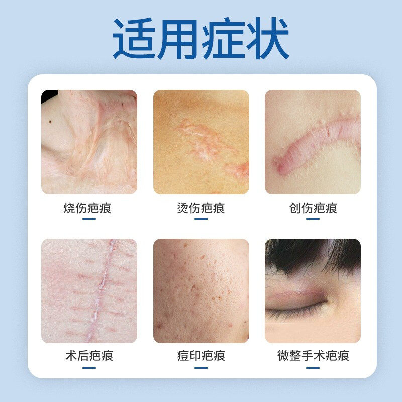 6s疤痕宁儿童祛疤膏手术去疤痕灵 金色福林医疗器械祛疤产品