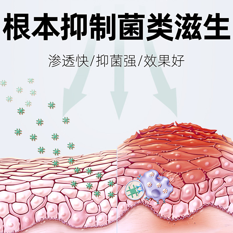 苗林阴痒净抑菌洁净祛味清除止痒膏 苗林皮肤消毒护理（消）