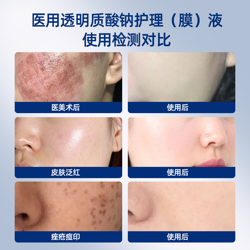 械字号医用透明质酸钠修复敷料医美激光术后舒缓非面膜女修护补水