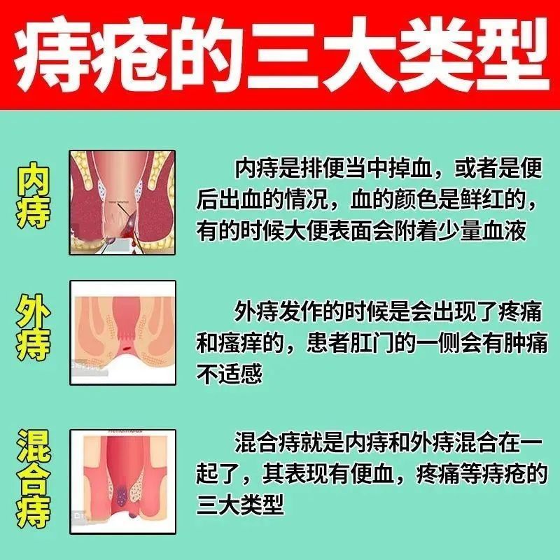 痔疮膏痔根断正品马应龙旗舰店官网消肉球女性痔疮特成效药进口XJ - 图1