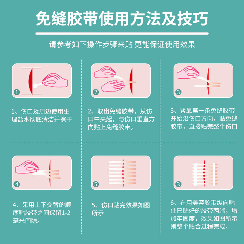 伤口免缝合贴减张贴减张器剖腹产疤痕贴医用术后儿童张力贴闭合器-图1