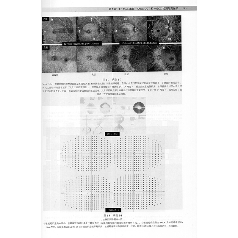 正版现货 En face-OCT及Angio-OCT技术与mGCC相关病变临床病变应用思考孙心铨科学出版社-图3