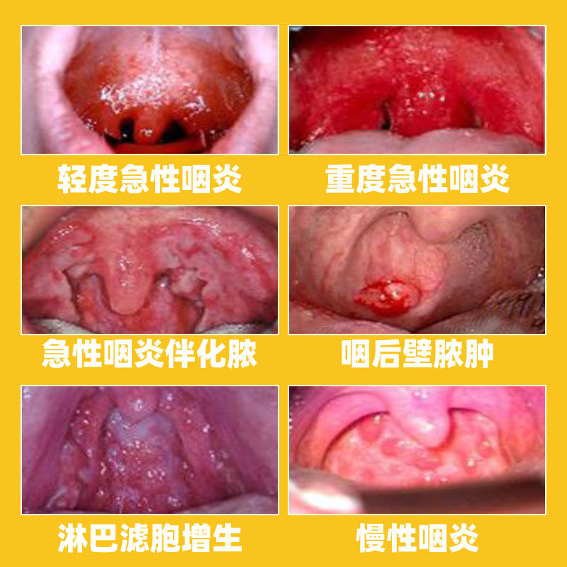 扁桃体结石去除工具隐窝冲洗器清理口腔喷雾漱口水咽喉吸引取口臭 - 图1