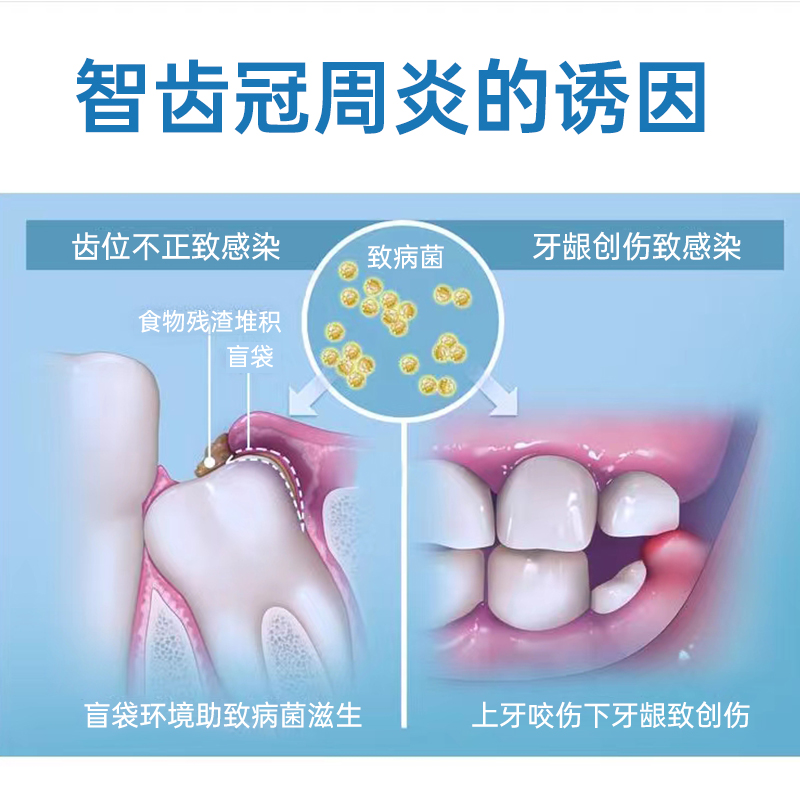 牙髓炎止疼牙根发炎牙神经肿痛牙龈萎缩出血消智齿疼痛效特药喷剂-图3