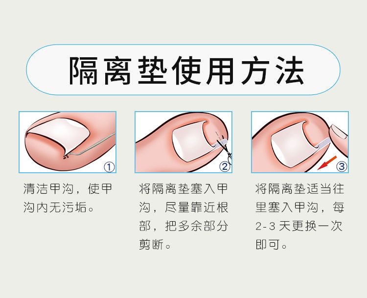 甲沟矫正器贴片炎嵌甲神器防脚指甲往肉里长专用治疗工具填充垫片 - 图3