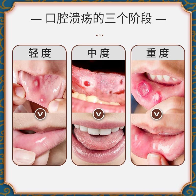 口腔溃疡喷剂儿童成人 利军医疗器械保健理疗