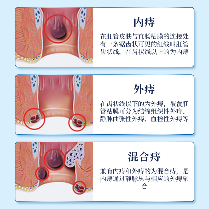 南京同仁堂槐实膏痔疮消肉球痣苍痔根断正品怀石非北京倪海厦枯散 - 图1