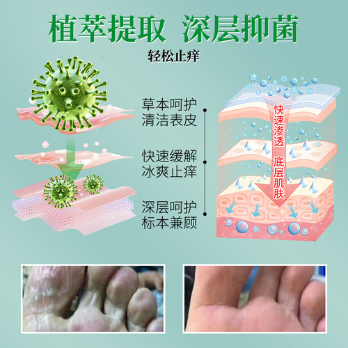 云南本草狼毒去除脚足部气抑菌喷雾剂止痒脱皮杀菌官方旗舰店正品 - 图1