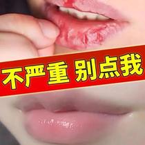(A Smear) Lip Gloss Special Moisturizing Lip Balm Medicinal Repair Nourishes Children Adult Lips Repeatedly Dry Cleft