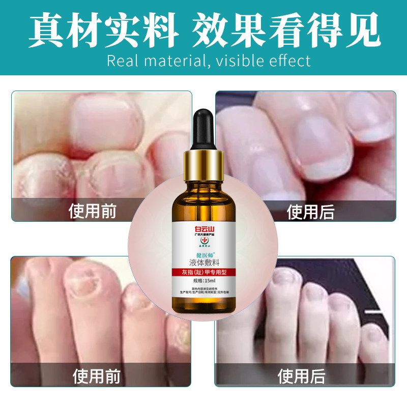 白云山液体敷料灰指甲脱甲抑菌液 信德堂大药房保健理疗