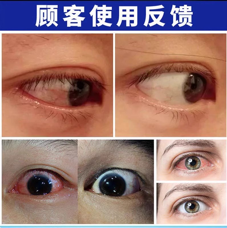 迎风流泪滴眼液流眼泪眼药水泪道堵塞眼睛经常怕冷风怕光干涩疲劳 - 图1