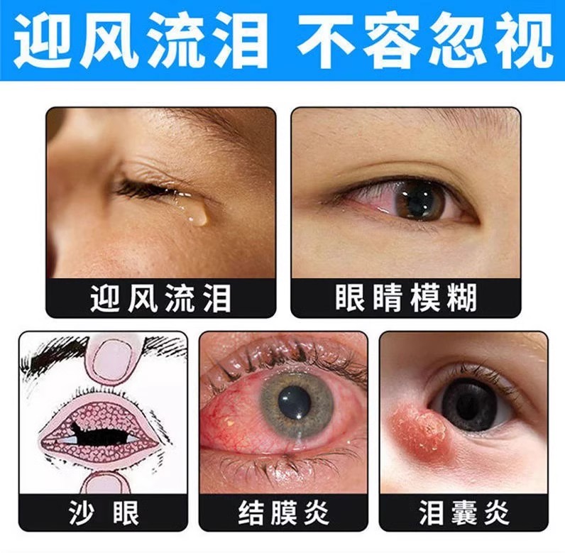 迎风流泪滴眼液流眼泪眼药水泪道堵塞眼睛经常怕冷风怕光干涩疲劳 - 图0