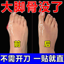 Thumb valgus (early use early Good) Thumb Valgus Muscle Sticking Large Toe Overlap Joint Swollen effective medicine YF