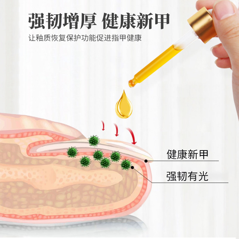 普迈迪甲沟炎手指脚趾灰指甲专用液 美适达医疗器械保健理疗