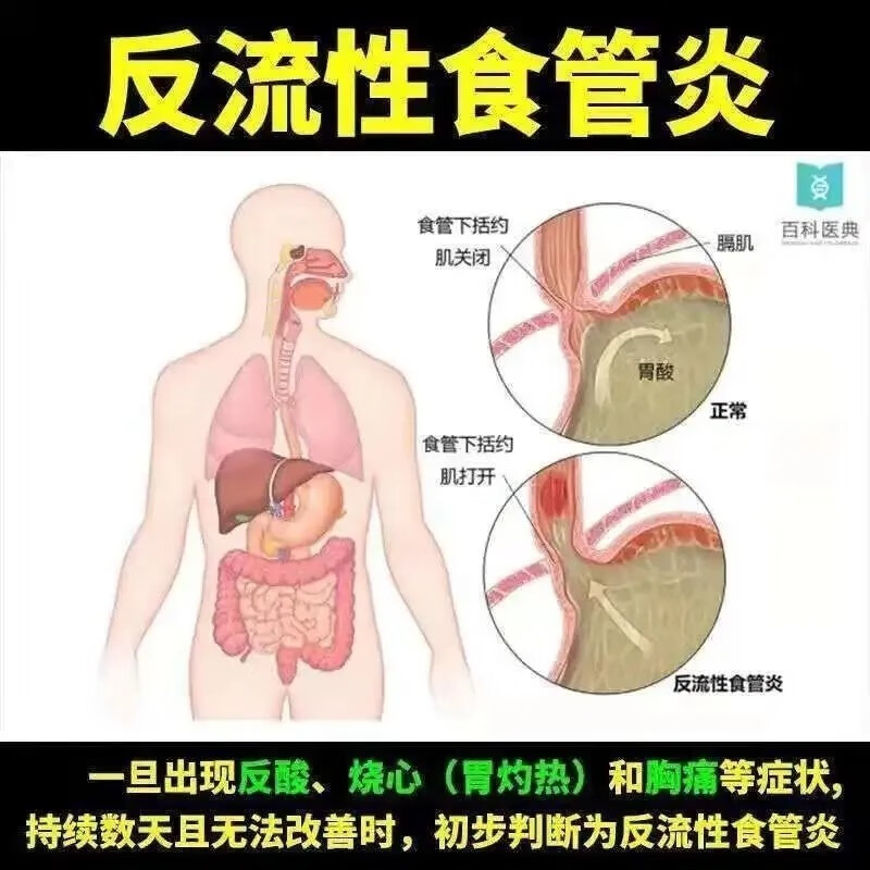 奥美拉唑肠溶胶囊正品胃药胃反酸烧心的药胃痛肠胃炎溃疡胃药BS - 图1