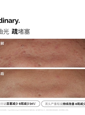 TheOrdinary30%温和无酸换肤平滑
