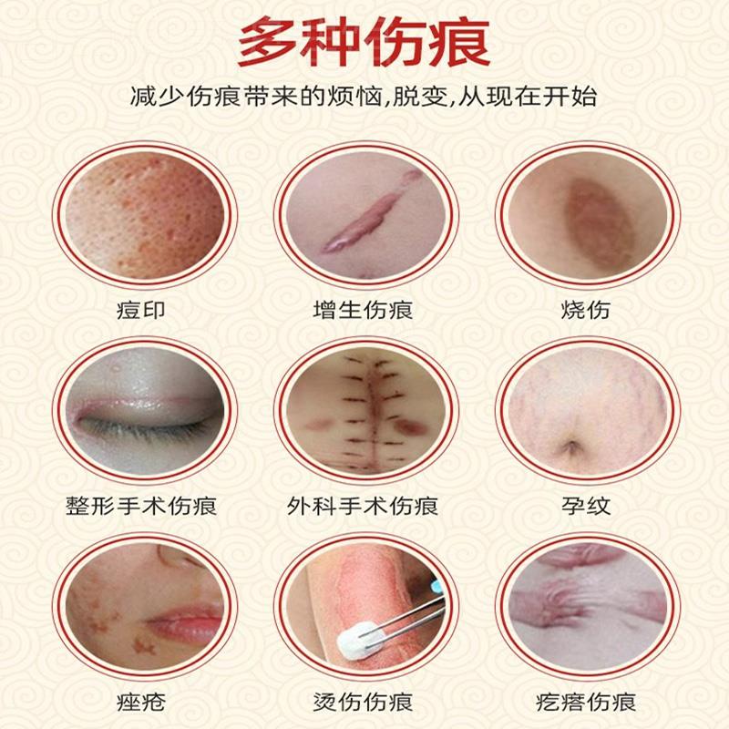 祛疤痕增生凸起去除胸前瘢痕疙瘩软化修复油烫伤疤手术疤痕专用膏 - 图1