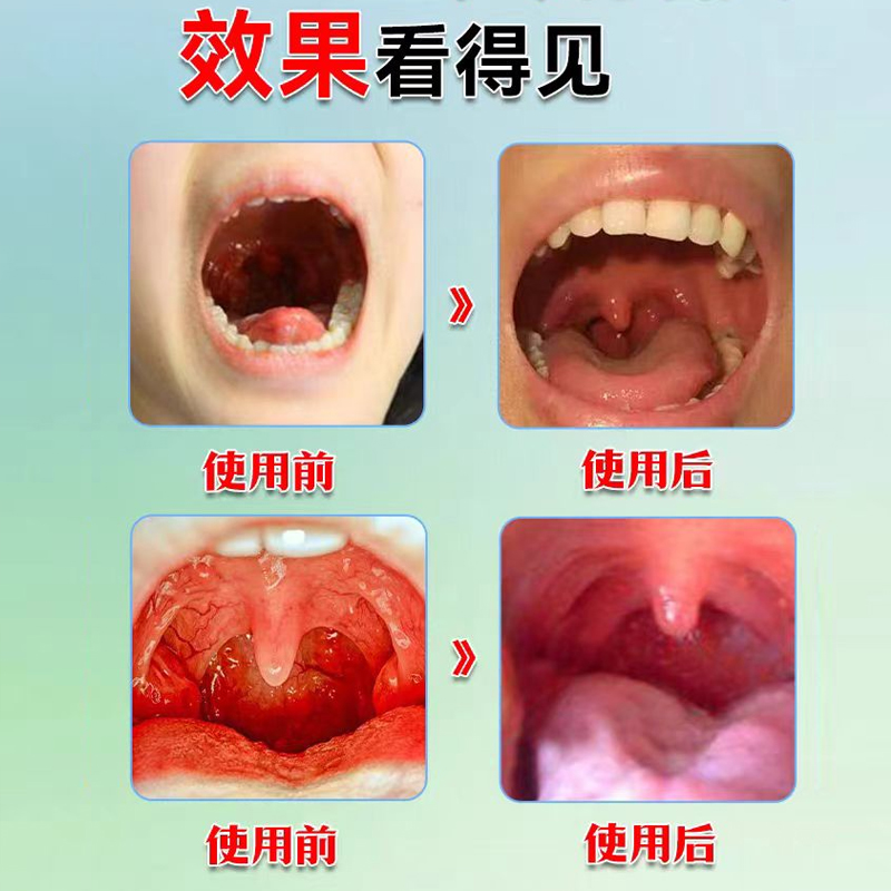 咽喉炎专用贴喉咙消炎慢性咽炎扁条体发炎肿痛干痒咳嗽化痰膏药贴 - 图1