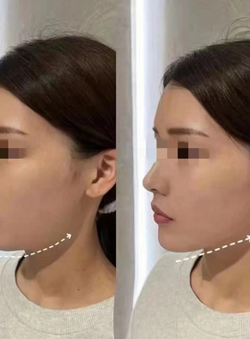 瓜子脸重组胶原蛋白V脸深层提拉紧致轮廓下颚线脸部轻薄娃娃正品