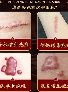 疤痕膏老手术疤凹凸摔伤增生疤痕