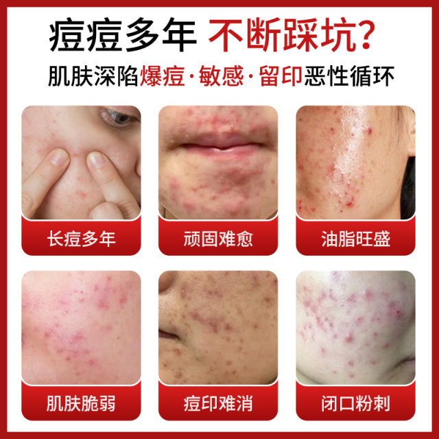 ສະພາບຜິວທີ່ເກີດສິວຈາກພາຍໃນສູ່ພາຍນອກ