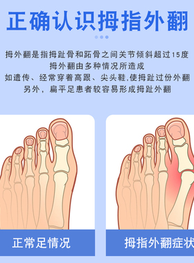 脚趾分离器大脚趾拇指外翻矫正器