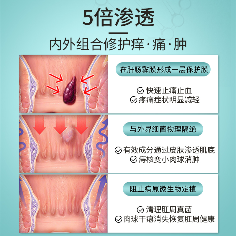 【自营】痔疮膏痔根断正品消痔疮康去肉球神器速达痔立克冷敷凝胶 - 图1