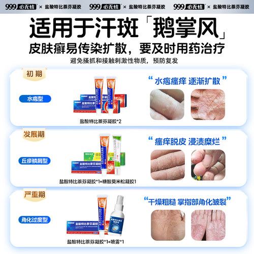 手癣膏脱皮干裂真菌感染鹅掌风专用手癣膏药盐酸特比萘芬正品凝胶 - 图0
