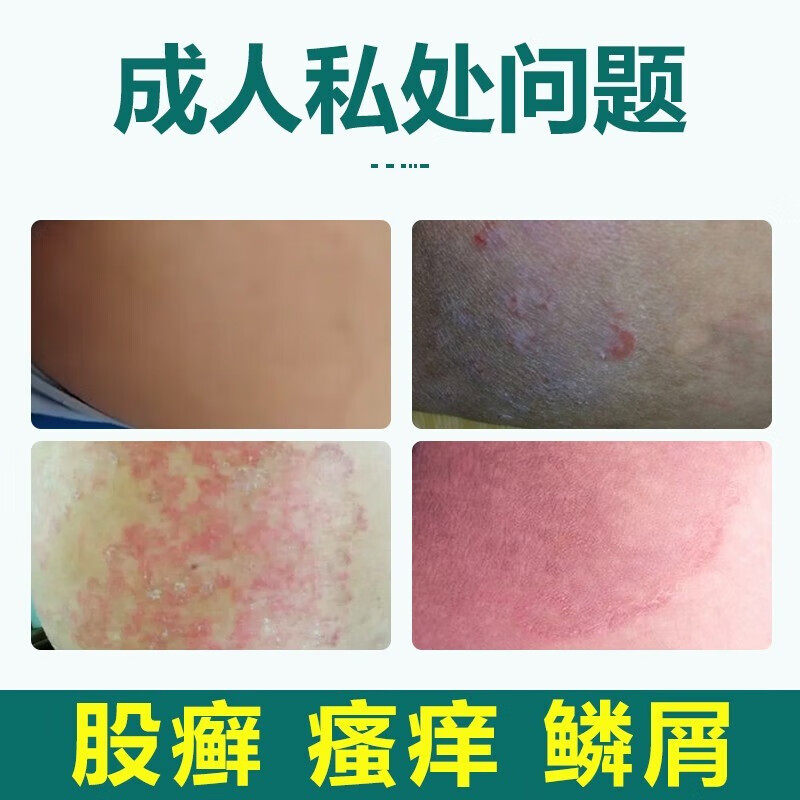 欧立沃大药房癣症