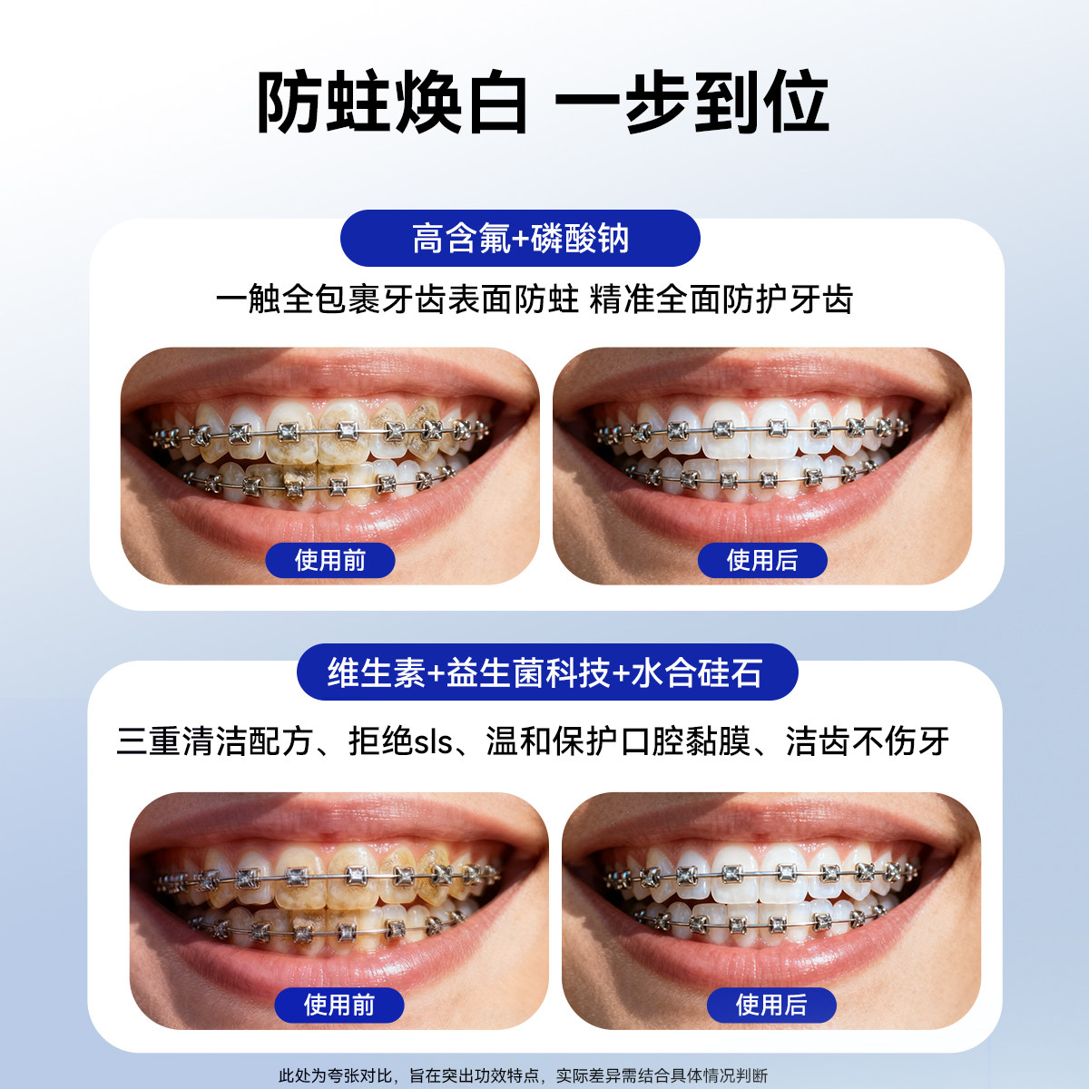 皓齿舒高含氟防蛀美白去渍牙膏正品正畸矫正牙齿专用成人雅克净