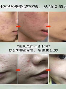 额头闭口粉刺的克儿星治脸上起小疙瘩儿童逆光疹闭合粉刺痤疮祛痘