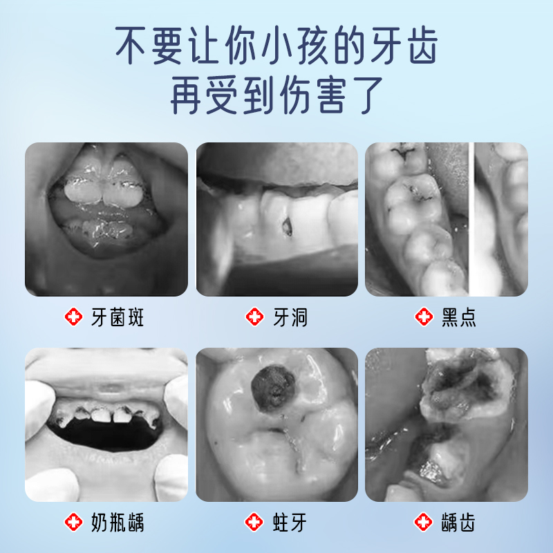 普迈迪口腔防蛀膏宝宝防蛀牙防龋齿固齿封闭牙窝沟点隙儿童型xu - 图1