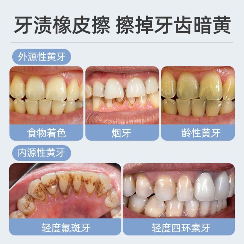 买2送1 牙白人更美 去黄牙黑牙结石烟渍茶渍污垢牙齿美白男女通用