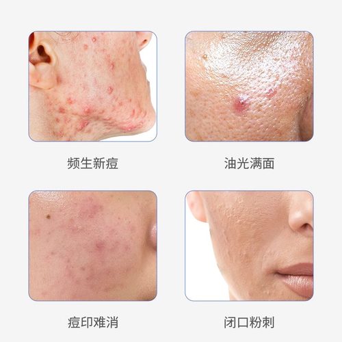 澳洲进口15%Finacea壬二酸凝胶乳膏软膏医用祛痘膏闭口粉刺痤疮 - 图1